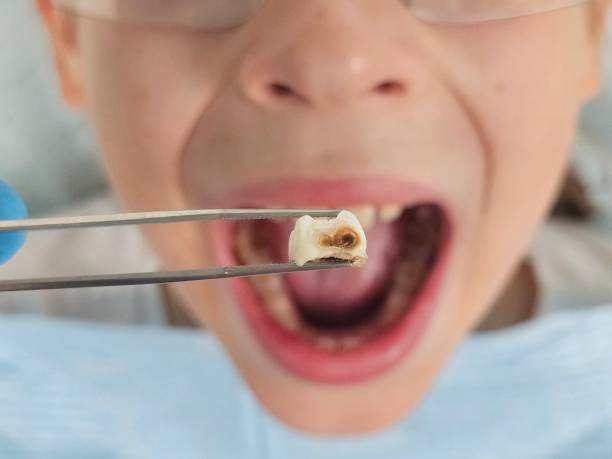 Best Emergency Tooth Extraction  in Ukiah, CA